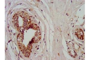 IHC image of ABIN7160564 diluted at 1:400 and staining in paraffin-embedded human breast cancer performed on a Leica BondTM system. (MYH11 anticorps  (AA 1655-1797))