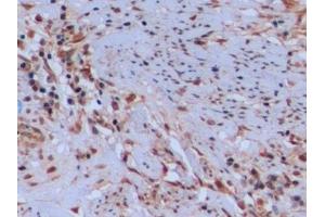 Detection of TYMS in Human Endometrial cancer Tissue using Polyclonal Antibody to Thymidylate Synthetase (TYMS)