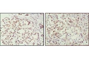 Immunohistochemical analysis of paraffin-embedded human breast cancer (left) and lung cancer (right) tissues, showing nuclear localization using MSH2 antibody with DAB staining. (MSH2 anticorps)