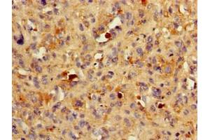 Immunohistochemistry of paraffin-embedded human melanoma using ABIN7145531 at dilution of 1:100 (BACE1 anticorps  (AA 46-155))
