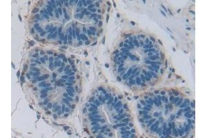 Detection of COL4a1 in Human Breast cancer Tissue using Polyclonal Antibody to Collagen Type IV Alpha 1 (COL4a1)