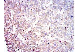 Immunohistochemical analysis of paraffin-embedded liver cancer tissues using COTL1 mouse mAb with DAB staining.