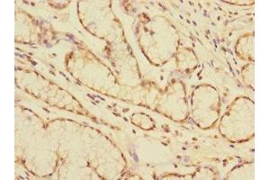Immunohistochemistry of paraffin-embedded human colon cancer using ABIN7146795 at dilution of 1:100