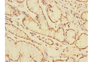Immunohistochemistry of paraffin-embedded human colon cancer using ABIN7146795 at dilution of 1:100 (CEACAM4 anticorps  (AA 36-155))