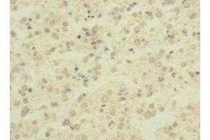Immunohistochemistry of paraffin-embedded human glioma using ABIN7143380 at dilution of 1:100 (ADGRB1 anticorps  (AA 60-350))