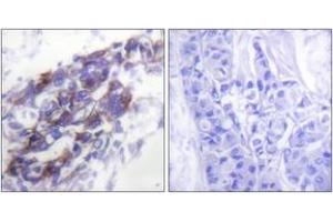 Immunohistochemistry analysis of paraffin-embedded human breast carcinoma tissue, using Keratin 8 Antibody. (KRT8 anticorps  (AA 434-483))
