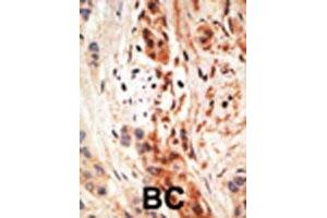 Formalin-fixed and paraffin-embedded human cancer tissue reacted with the APOBEC3A polyclonal antibody  , which was peroxidase-conjugated to the secondary antibody, followed by AEC staining. (APOBEC3A anticorps  (N-Term))