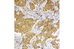 Anti-Hsc70 antibody, IHC(P) IHC(P): Human Lung Cancer Tissue (Hsc70 anticorps  (C-Term))