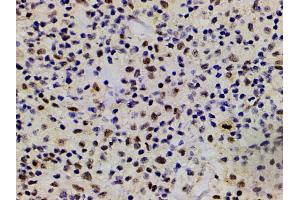 ABIN6267554 at 1/200 staining human lymphoma tissue sections by IHC-P.
