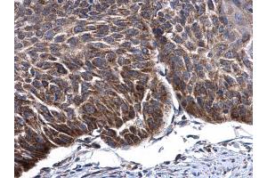 IHC-P Image mtTFA antibody detects mtTFA protein at cytoplasm in human esophagus cancer by immunohistochemical analysis.