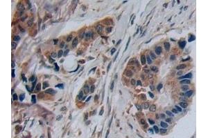 Detection of DISC1 in Human Breast cancer Tissue using Polyclonal Antibody to Disrupted In Schizophrenia 1 (DISC1) (DISC1 anticorps  (AA 102-261))