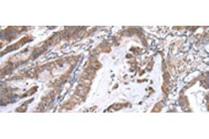Immunohistochemistry of paraffin-embedded Human esophagus cancer tissue using WWP1 Polyclonal Antibody at dilution of 1:40(x200) (WWP1 anticorps)