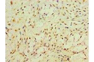 Immunohistochemistry of paraffin-embedded human breast cancer using ABIN7166493 at dilution of 1:100