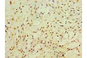 Immunohistochemistry of paraffin-embedded human breast cancer using ABIN7166493 at dilution of 1:100 (Ret Proto-Oncogene anticorps  (AA 29-300))