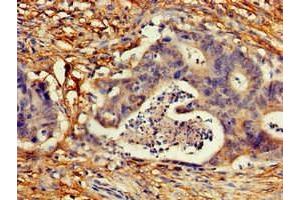 Immunohistochemistry of paraffin-embedded human colon cancer using ABIN7148889 at dilution of 1:100 (CDKN2C anticorps  (AA 1-68))