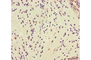 Immunohistochemistry of paraffin-embedded human lung cancer using ABIN7154798 at dilution of 1:100 (GAR1 anticorps  (AA 1-217))