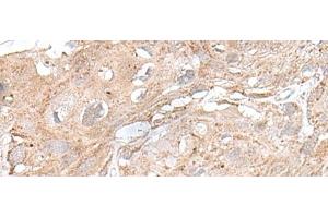 Immunohistochemistry of paraffin-embedded Human esophagus cancer tissue using SNRNP25 Polyclonal Antibody at dilution of 1:65(x200) (SNRNP25 anticorps)