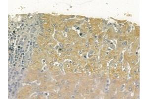 ABIN6257004 and ABIN6275941 at 1/100 staining human hepatocellular carcinoma by IHC-P.