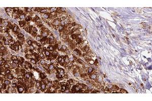 ABIN6272688 at 1/100 staining Human liver cancer tissue by IHC-P.