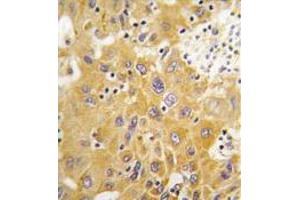 Formalin-fixed and paraffin-embedded human hepatocarcinoma tissue reacted with CAMK1-like Antibody (C-term) , which was peroxidase-conjugated to the secondary antibody, followed by DAB staining. (CAMK1D anticorps  (C-Term))