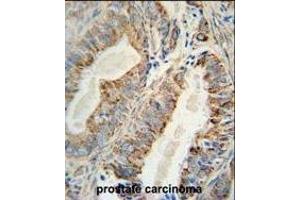 AKT2 Monoclonal Antibody (ABIN659024 and ABIN2838047) immunohistochemistry analysis in formalin fixed and paraffin embedded human prostate carcinoma followed by peroxidase conjμgation of the secondary antibody and DAB staining. (AKT2 anticorps)