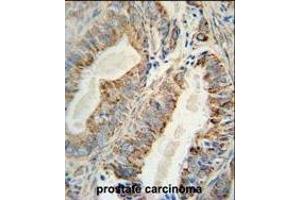 AKT2 Monoclonal Antibody (ABIN659024 and ABIN2838047) immunohistochemistry analysis in formalin fixed and paraffin embedded human prostate carcinoma followed by peroxidase conjμgation of the secondary antibody and DAB staining. (AKT2 anticorps)