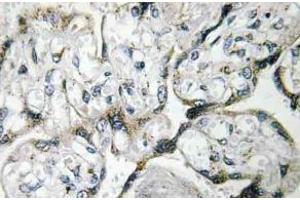 Immunohistochemistry (IHC) analyzes of PAKalpha antibody in paraffin-embedded human breast carcinoma tissue. (PAK1 anticorps)