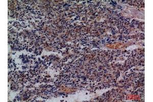 Immunohistochemistry (IHC) analysis of paraffin-embedded Human Lung Cancer, antibody was diluted at 1:100. (CD48 anticorps  (Internal Region))