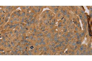 Immunohistochemistry of paraffin-embedded Human breast cancer tissue using PARP11 Polyclonal Antibody at dilution 1:30 (PARP11 anticorps)