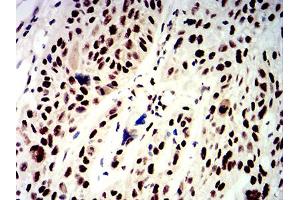 Immunohistochemical analysis of paraffin-embedded esophageal cancer tissues using APEX1 mouse mAb with DAB staining. (APEX1 anticorps  (AA 219-318))