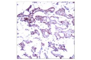 Immunohistochemical analysis of paraffin- embedded human breast carcinoma tissue using Elk-1 (Ab-389) antibody (E021037). (ELK1 anticorps)