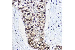 Immunohistochemistry of paraffin-embedded human lung cancer using SM Rabbit pAb (ABIN6132562, ABIN6148098, ABIN6148099 and ABIN6214424) at dilution of 1:100 (40x lens).