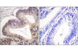 Immunohistochemistry analysis of paraffin-embedded human colon carcinoma, using PAK2 (Phospho-Ser20) Antibody.