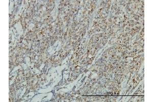 Immunoperoxidase of monoclonal antibody to JUP on formalin-fixed paraffin-embedded human lymphoma tissue.