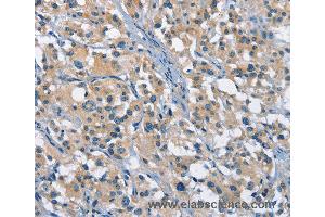 Immunohistochemistry of Human gastric cancer using GAS2 Polyclonal Antibody at dilution of 1:50
