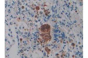 Detection of PTPRQ in Human Lung cancer Tissue using Polyclonal Antibody to Protein Tyrosine Phosphatase Receptor Type Q (PTPRQ) (PTPRQ anticorps  (AA 36-294))