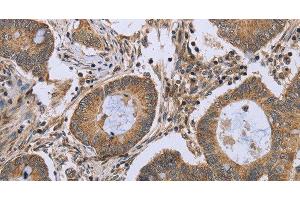 Immunohistochemistry of paraffin-embedded Human colon cancer using FKBP8 Polyclonal Antibody at dilution of 1:50 (FKBP8 anticorps)