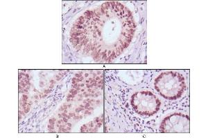 Immunohistochemical analysis of paraffin-embedded human colon cancer (A), gastric cancer (B) and rectal cancer (C) tissues using FOXA2 antibody with DAB staining. (FOXA2 anticorps)