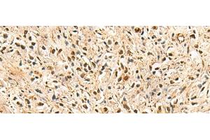 Immunohistochemistry of paraffin-embedded Human prost ate cancer tissue using PSMA3 Polyclonal Antibody at dilution of 1:50(x200) (PSMA3 anticorps)