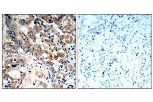 Immunohistochemical analysis of paraffin-embedded human lung carcinoma tissue, using AMPK-alpha,1/AMPK-alpha,2(Phospho-Thr174/Thr172) Antibody.
