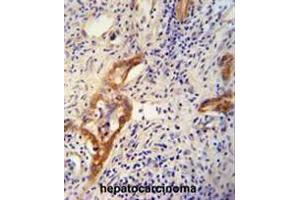 CLPX antibody (C-term) immunohistochemistry analysis in formalin fixed and paraffin embedded human hepatocarcinoma followed by peroxidase conjugation of the secondary antibody and DAB staining. (CLPX anticorps  (C-Term))