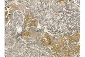 ABIN6262005 and ABIN6273249 at 1/100 staining human lung adenocarcinoma by IHC-P. (GMFG anticorps  (Internal Region))