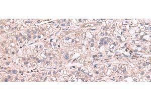 Immunohistochemistry of paraffin-embedded Human liver cancer tissue using KCNIP1 Polyclonal Antibody at dilution of 1:60(x200) (KCNIP1 anticorps)