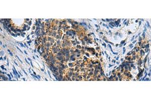 Immunohistochemistry of paraffin-embedded Human prost ate cancer tissue using PLIN4 Polyclonal Antibody at dilution of 1:50(x200)