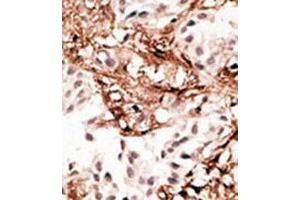 Immunohistochemical staining (Formalin-fixed paraffin-embedded sections) of human breast cancer tissue with MAP1LC3C polyclonal antibody  at 1:50-100 dilution. (LC3C anticorps  (AA 1-30))