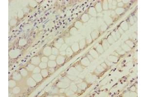 Immunohistochemistry of paraffin-embedded human colon cancer using ABIN7166731 at dilution of 1:100 (NSUN7 anticorps  (AA 1-300))