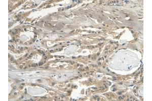 Detection of Cys-C in Human Thyroid cancer Tissue using Monoclonal Antibody to Cystatin C (Cys-C) (Cystathionine-gamma-Synthase Precursor (CYS) (AA 27-146) anticorps)