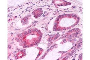 Anti-CCR3 antibody IHC of human Prostate, Carcinoma.