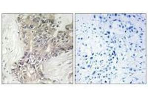 Immunohistochemistry analysis of paraffin-embedded human liver carcinoma tissue using B3GALTL antibody. (B3GALTL anticorps  (C-Term))