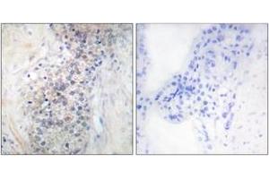 Immunohistochemistry analysis of paraffin-embedded human prostate carcinoma tissue, using LRAT Antibody. (LRAT anticorps  (AA 111-160))